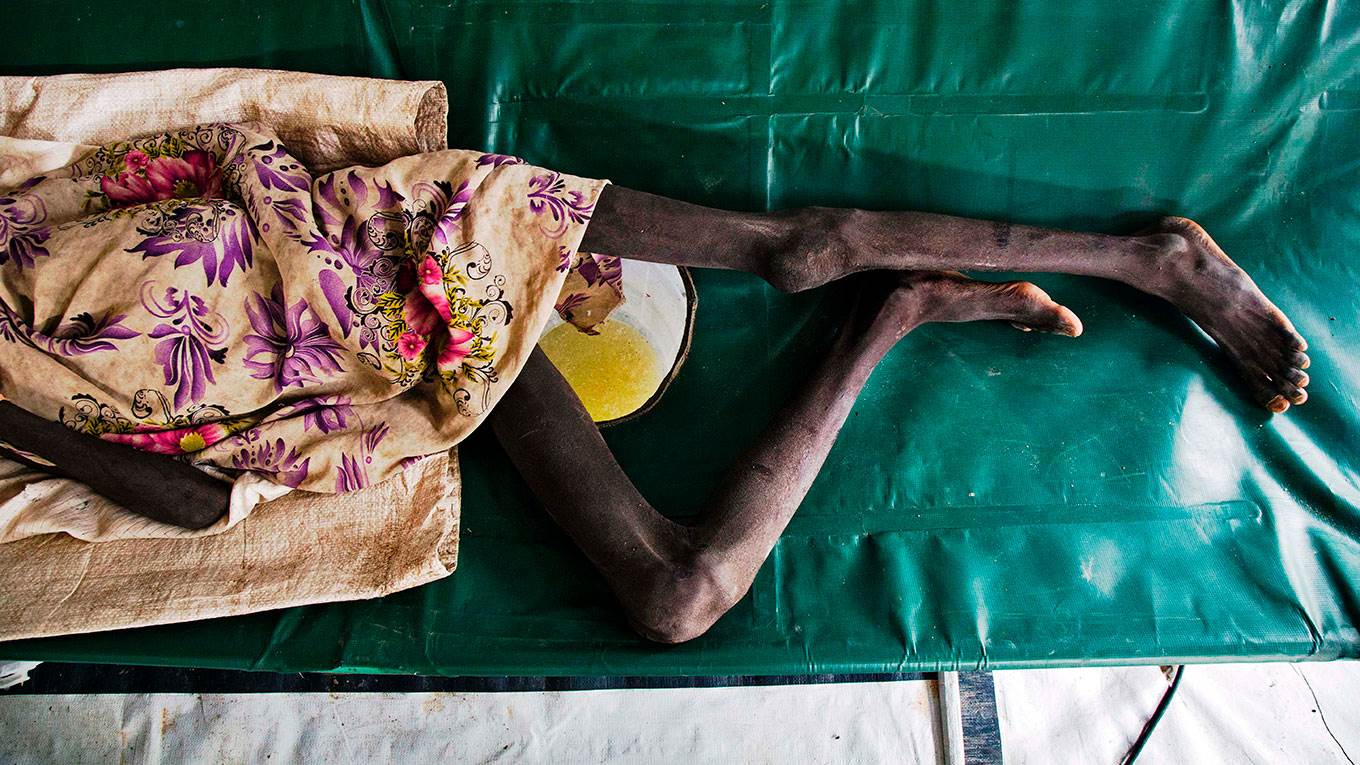 A girl seriously affected with cholera